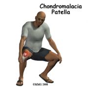 http://www.eorthopod.com/public/patient_education/9738/chondromalacia_patella.html (από nick, 02/12/09)