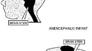 Anencephaly (από allivegp, 05/05/10)
